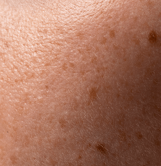 Correcting Pigment at the Source: Melanin Overproduction, & Peptide-Based Solutions