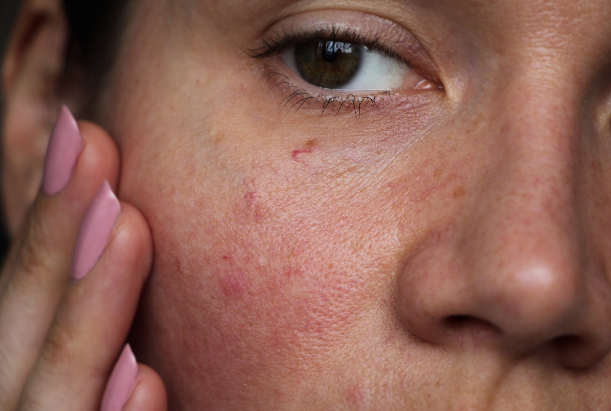 Skin Barrier Dysfunction and Chronic Inflammation in Rosacea, Eczema, and Psoriasis